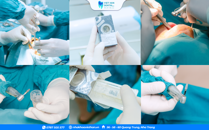 Thực hiện ghép xương trong trồng răng Implant tại Nha khoa Việt Hàn