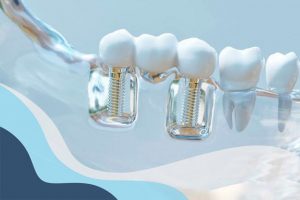 mat-rang-xen-ke-co-cay-ghep-implant-duoc-khong