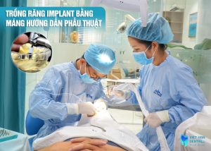 dia-chi-cay-ghep-implant-Nha-Trang-tot-nhat-hien-nay