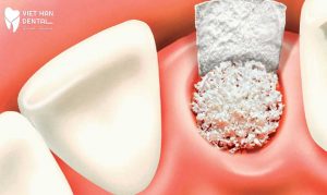 dia-chi-cay-ghep-implant-an-toan-tai-Nha-Trang
