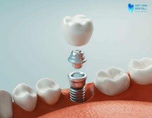 trong-rang-implant-co-giu-duoc-vinh-vien-khong