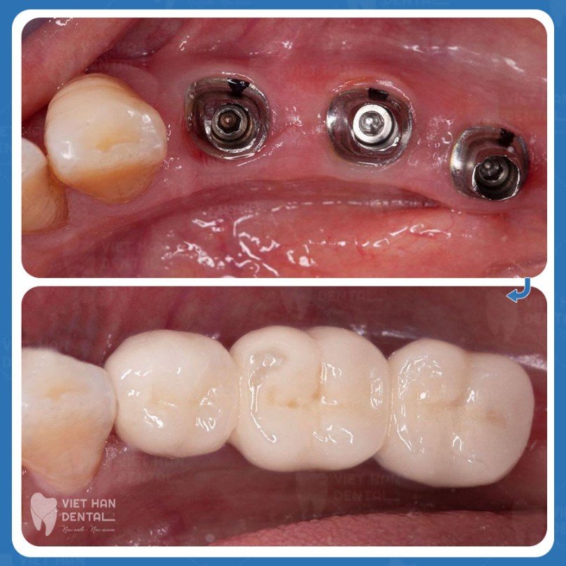 trong-rang-implant-su-dung-duọc-lau-khong