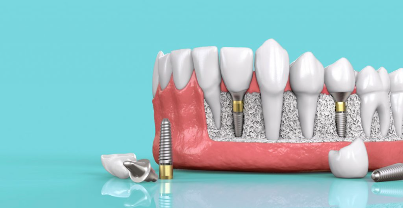 Dưới 18 tuổi không nên trồng răng Implant