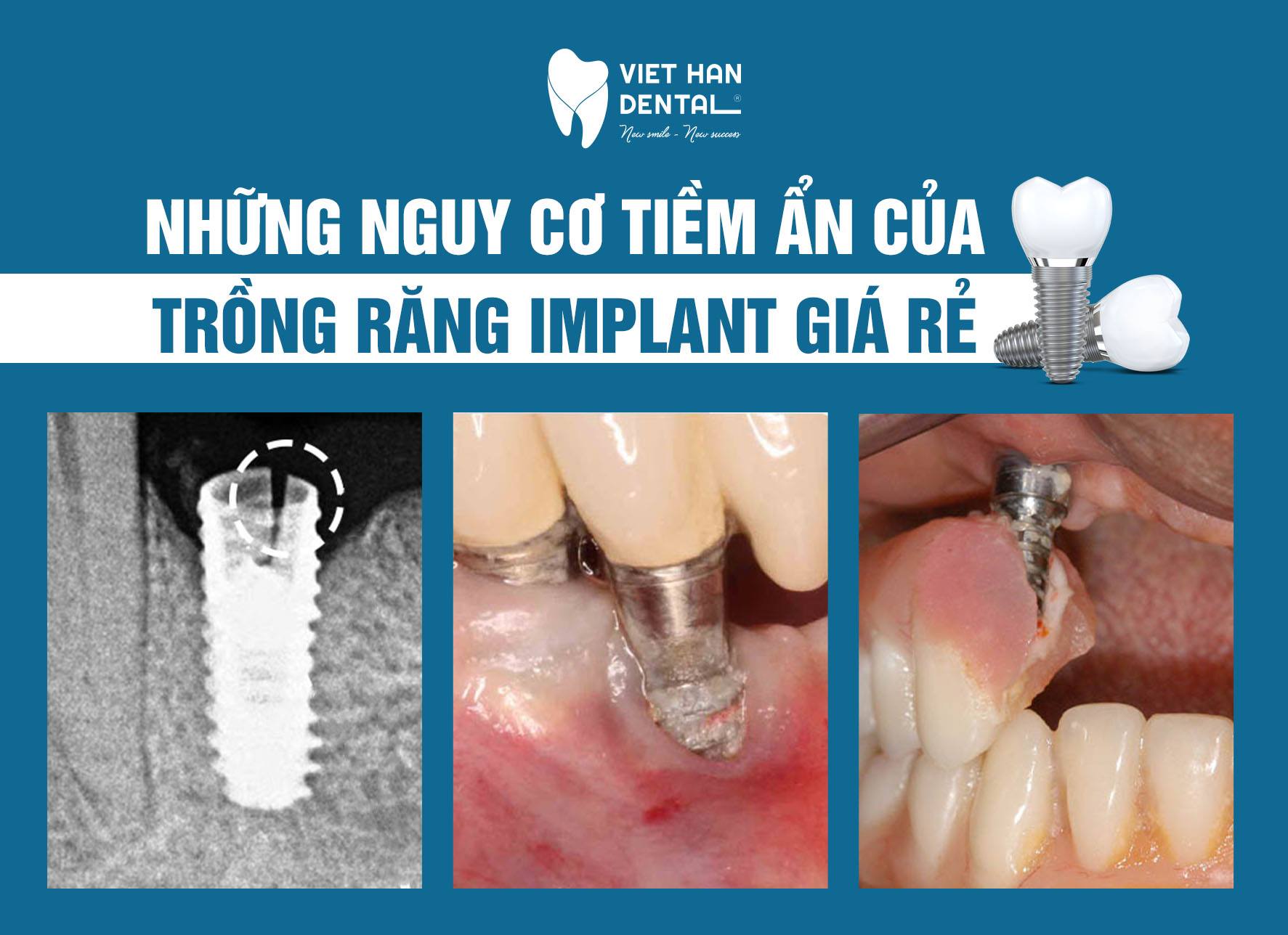 hau-qua-khi-trong-rang-implant-gia-re