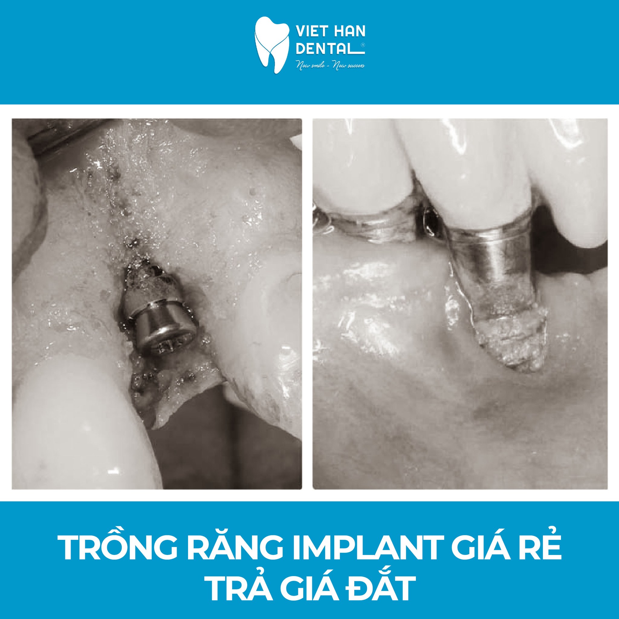 hau-qua-khi-trong-rang-implant-gia-re