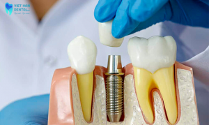 trong-rang-implant-xong-bao-lau-phai-lam-lai