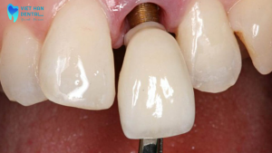 trong-rang-implant-co-giu-duoc-vinh-vien-khong