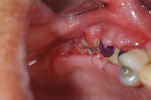 bien-chung-khi-trong-implant-sai-cach
