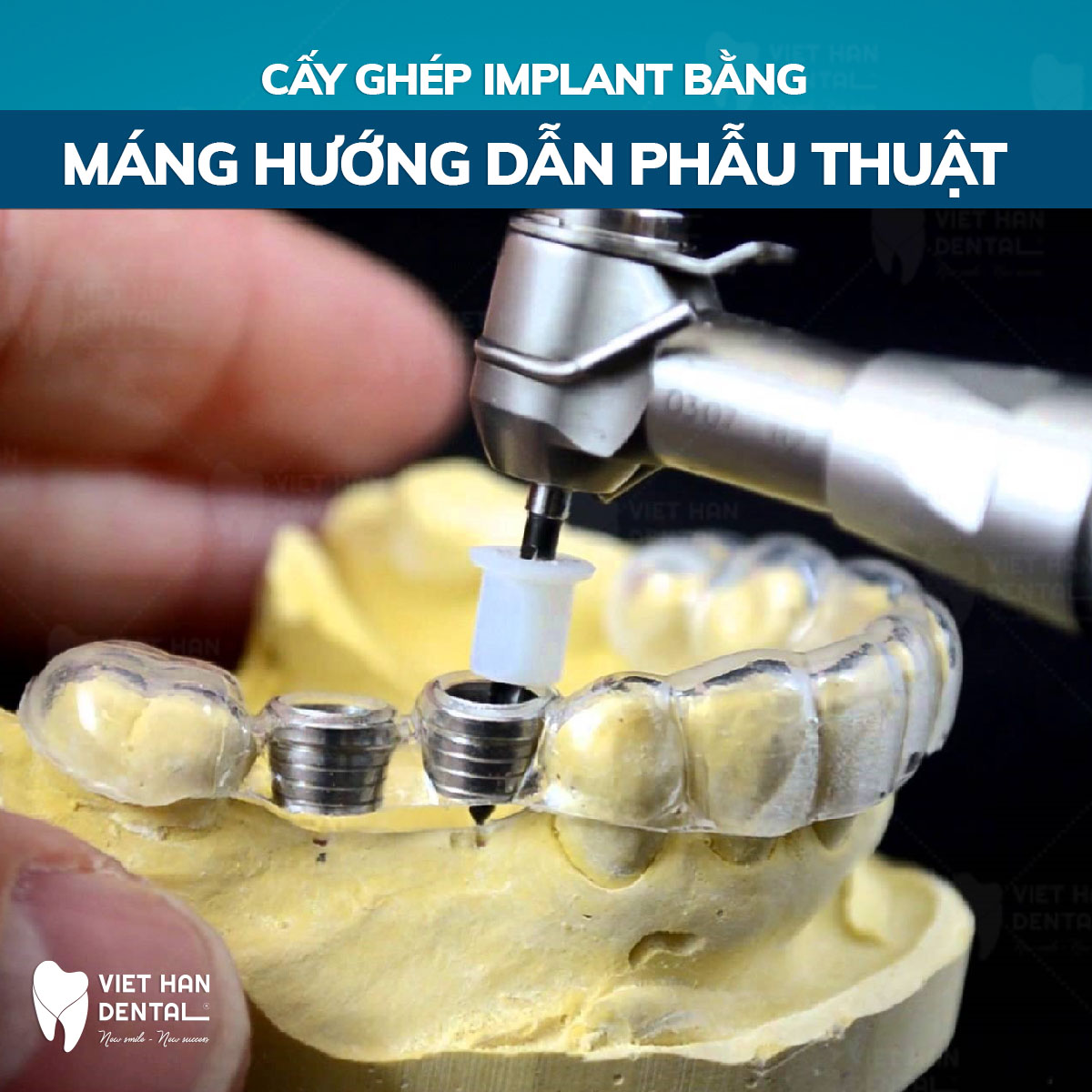 cap-nhat-bang-gia-cay-ghep-implant-moi-nhat-nha-trang-2023