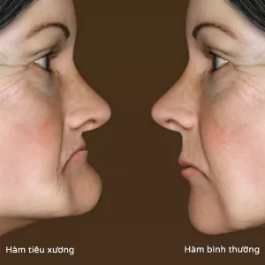 nho-rang-bao-lau-thi-trong-lai-duoc
