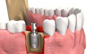 60-tuoi-trong-implant-co-duoc-khong