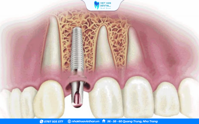 Kỹ thuật trồng răng của bác sĩ cũng là yếu tố quyết định sự thành công của ca cấy ghép