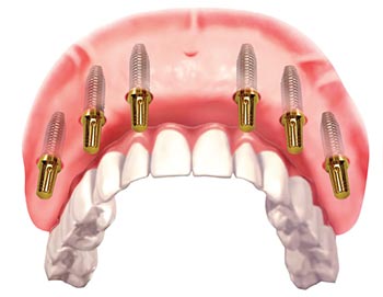 implant-all-on-6-giai-phap-cho-nguoi-mat-rang-toan-ham