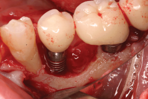 nguyen-nhan-implant-bi-dao-thai