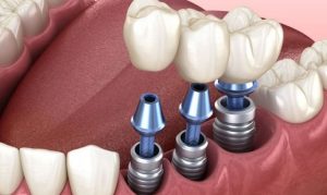 diem-manh-cua-trong-rang-implant