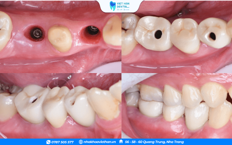Trồng răng Implant khôi phục những chiếc răng đã mất