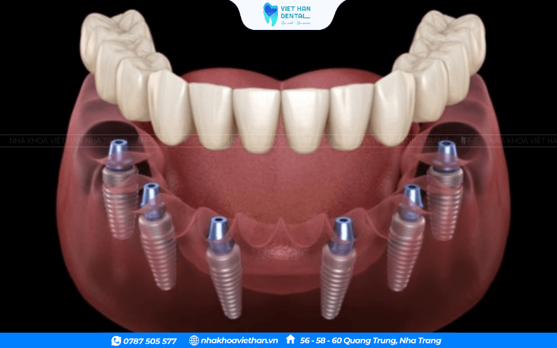 Trồng răng toàn hàm All-on-6