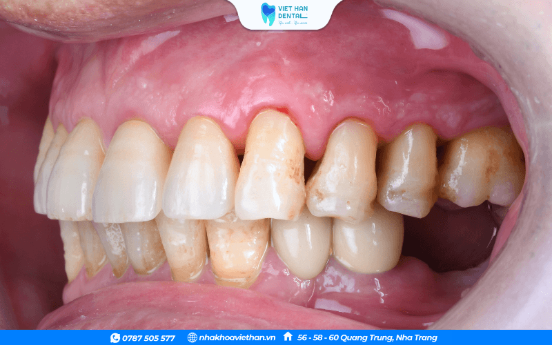 Trồng răng Implant là phương pháp hiệu quả để khôi phục những chiếc răng đã mất