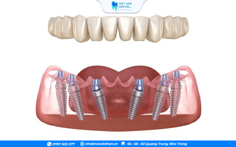 Kỹ thuật tiên tiến chỉ cần số lượng trụ Implant tối ưu để nâng đỡ toàn bộ hàm răng