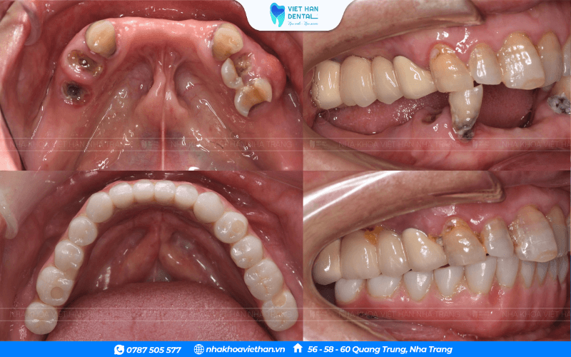 Sau khi trồng răng Implant Cô chú, Anh chị có thể ăn nhai như răng thật